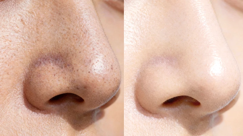 Oil Control & Pore Refining
